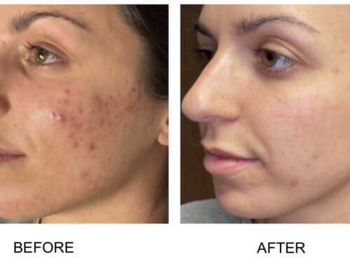 Transform Your Skin and Confidence: Acne Treatments at 901 Aesthetics in Germantown, Tennessee