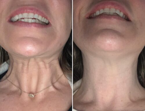 Correct the Neck: The Nefertiti Neck Lift at 901 Aesthetics