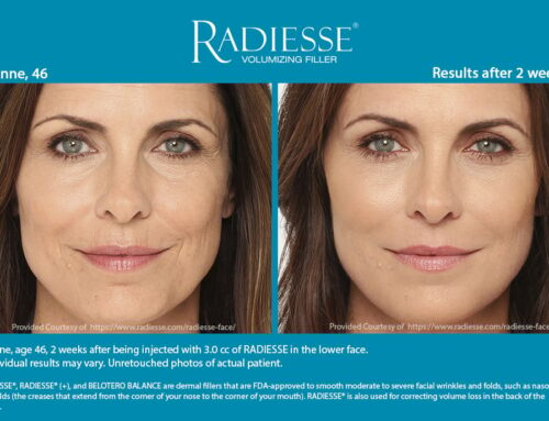 The Benefits of Radiesse in Germantown, Tennessee