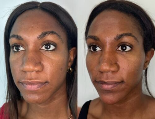 Facial Contouring in Germantown, Tennessee