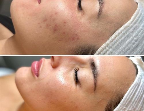 SkinPen Providers Near Southaven, Mississippi: What to Look for Before You Book | 901 Aesthetics