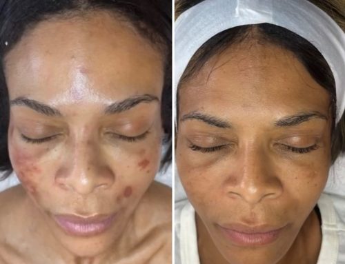 Professional Microneedling Near Southaven, Mississippi: SkinPen vs. Everything Else | 901 Aesthetics