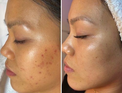 Collagen Induction Therapy for Southaven, Mississippi: SkinPen Precision Explained | 901 Aesthetics