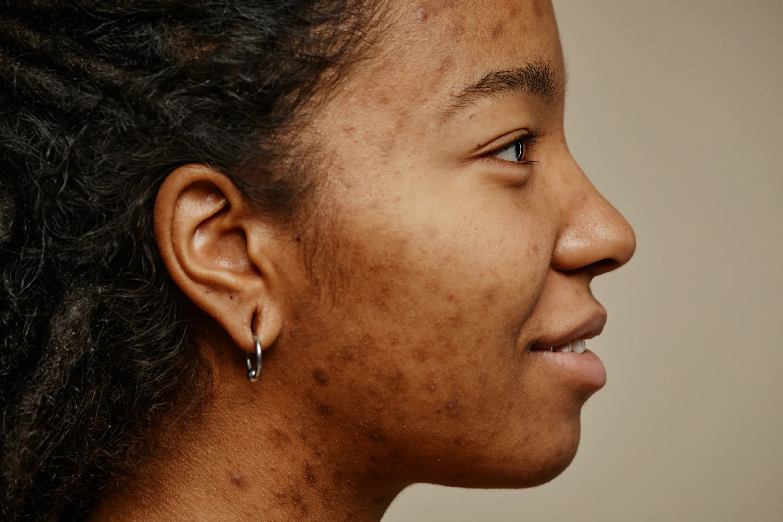 Sign 3 Acne Scars That Stayed After the Breakouts Cleared