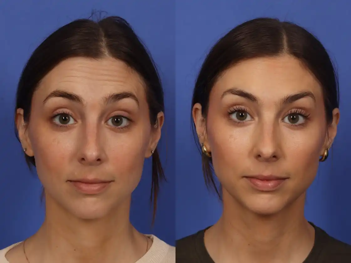 Botox Before and After Results by 901aesthetics Botox Before and After Results by 901aesthetics