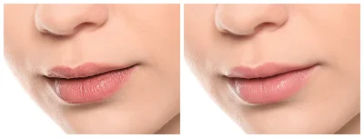 Dermal Filler before and after Results at 901 Aesthetics Dermal Filler before and after Results at 901 Aesthetics