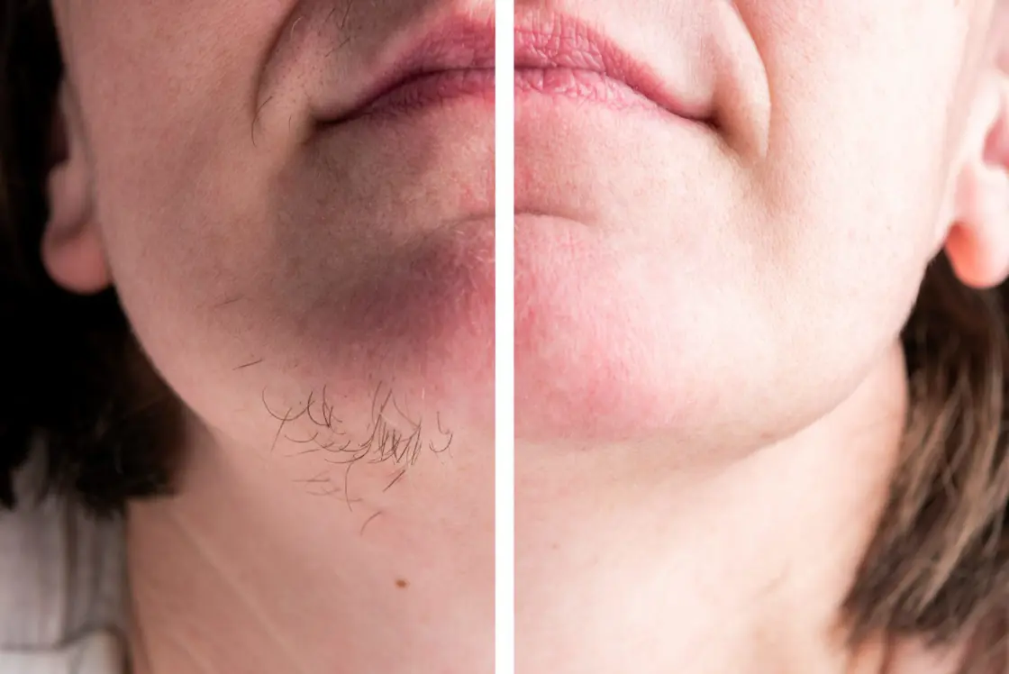 Before & After Results Laser Hair Removal By 901