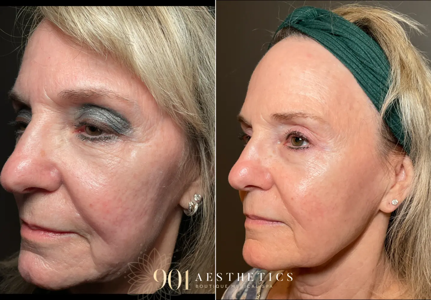 Before & After Results Laser Skin Resurfacing Germantown
