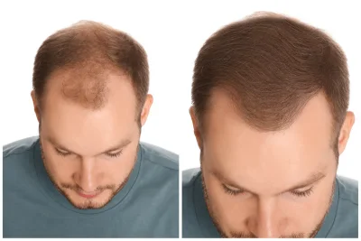 Before and After Results Hair Restoration Treatment