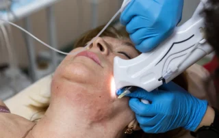 Is Laser Skin Resurfacing Worth It for Fine Lines and Sun Damage