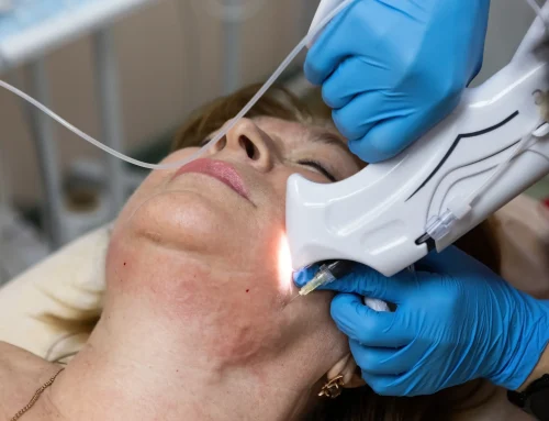Is Laser Skin Resurfacing Worth It for Fine Lines and Sun Damage?