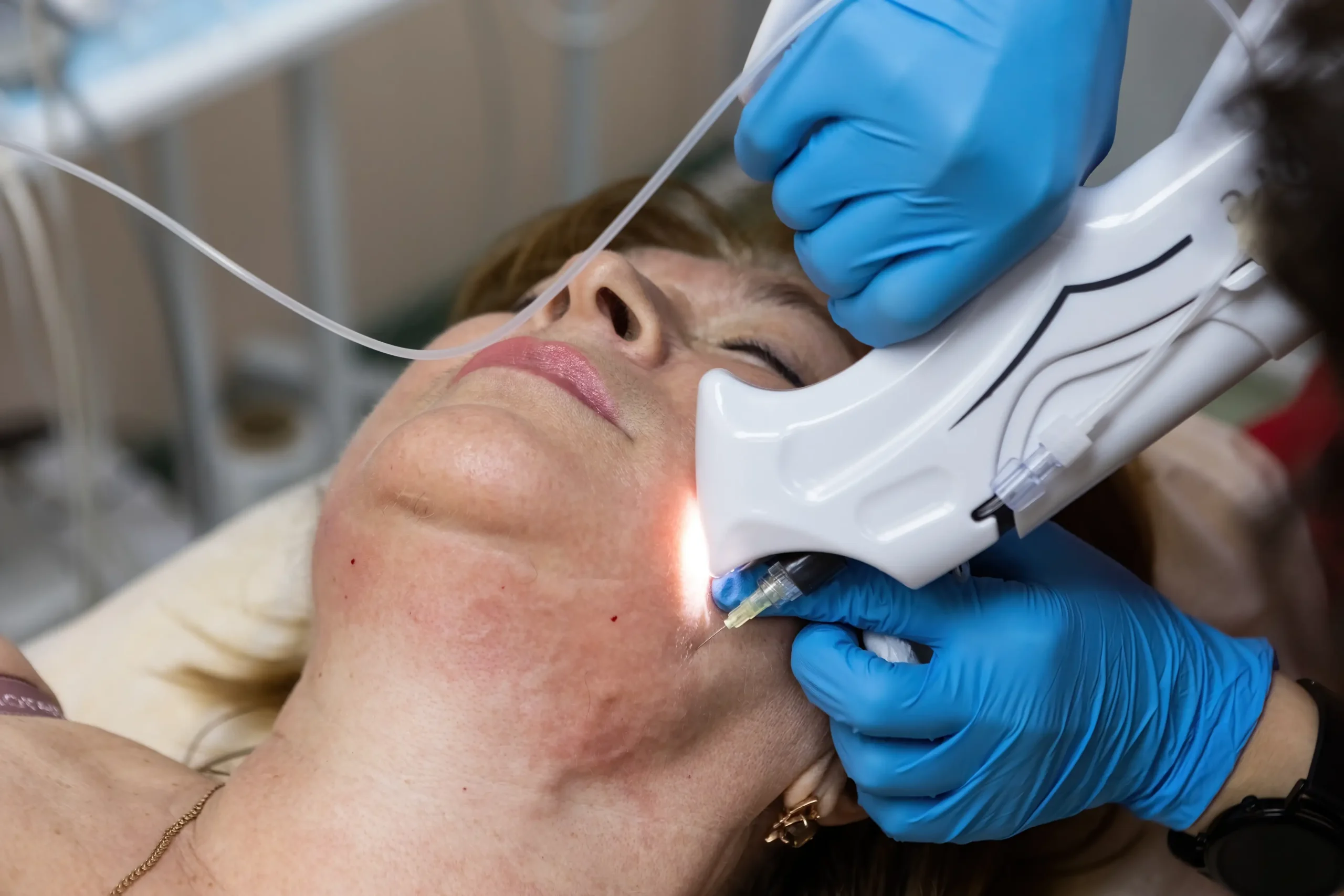 Is Laser Skin Resurfacing Worth It for Fine Lines and Sun Damage